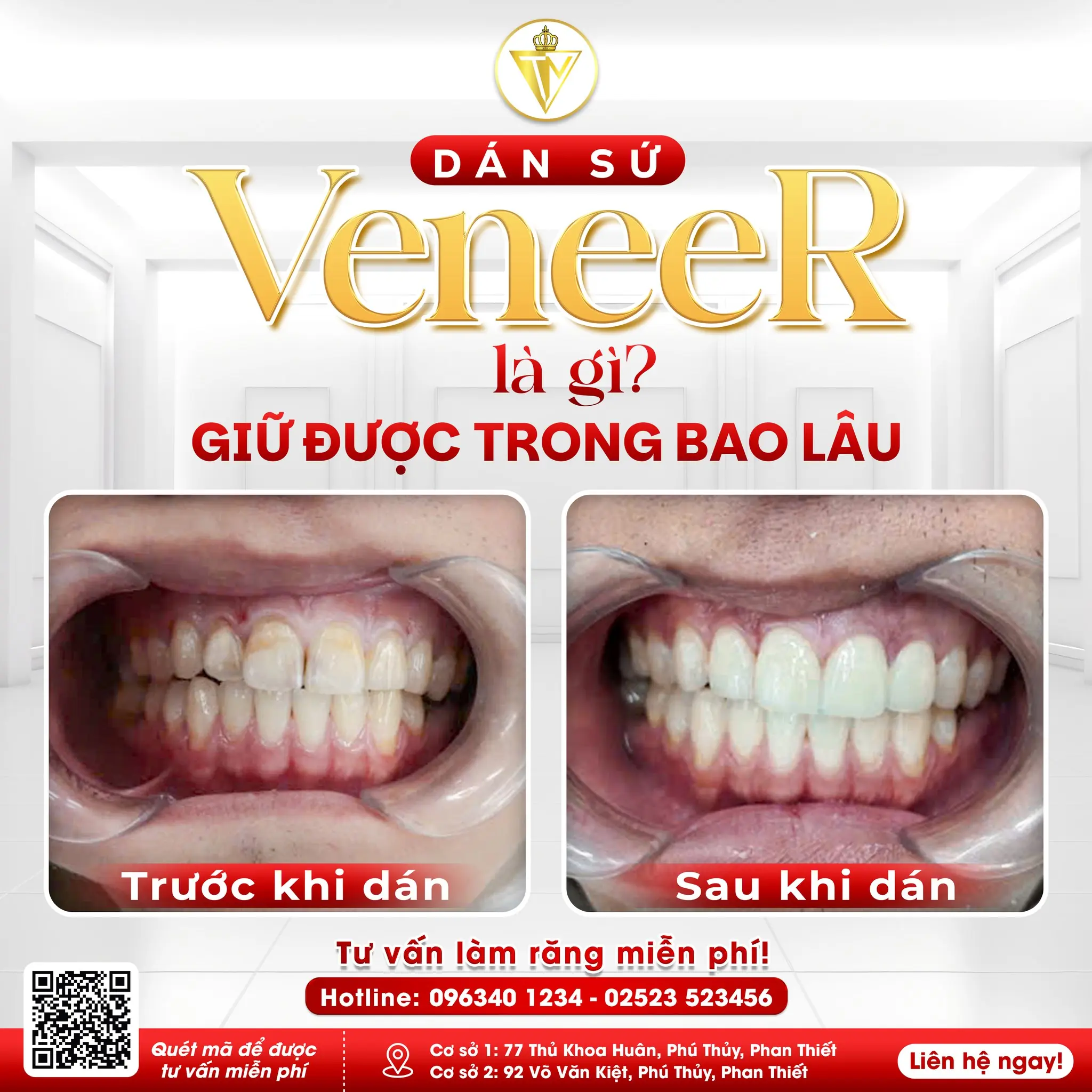 DÁN SỨ VENEER: ĐỈNH CAO THẨM MỸ - BẢO TỒN TỐI ĐA RĂNG GỐC 
